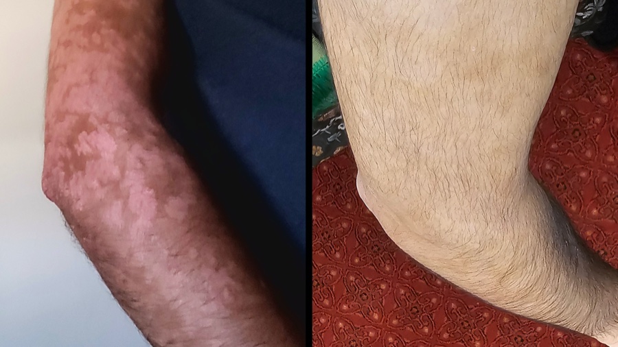 Abe's arm before treatment, with raised psoriasis plaques, beside the same arm after treatment with clear skin