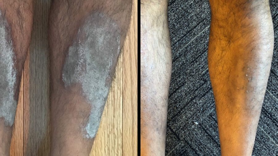 Philip's lower leg before treatment, with a large scaly plaque, beside the same leg after treatment with clear skin