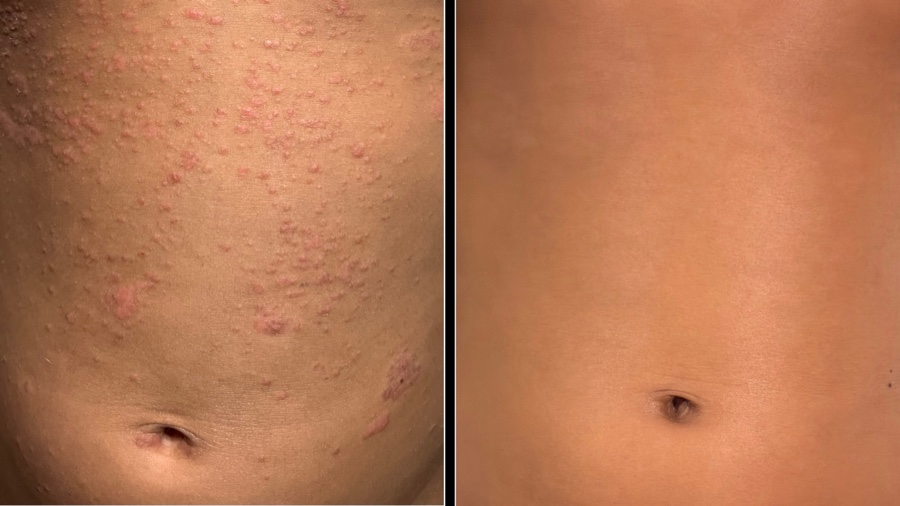 Skin before treatment, covered in raised psoriasis lesions, beside the same area after treatment with clear skin